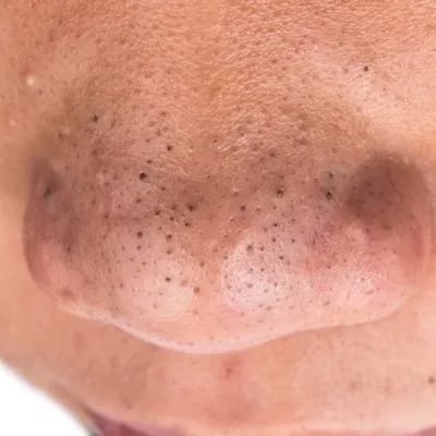 Close-up of a person’s nose showing visible enlarged pores.
