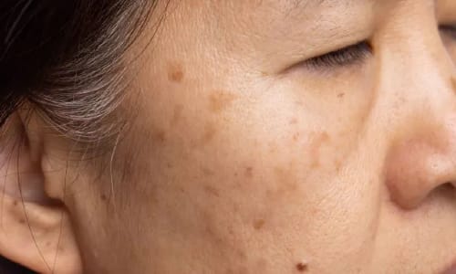 Age spots on the right side of an Asian woman’s face near the eye and cheek.