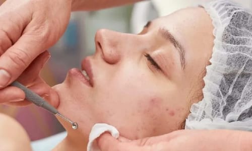 Female client receiving an extraction treatment to clear clogged pores.