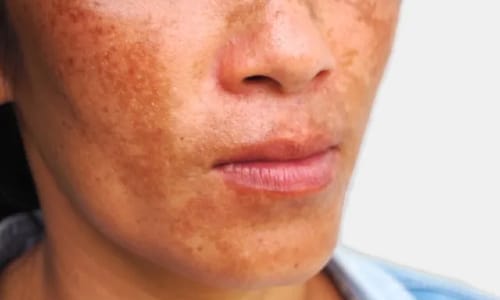 Pigmentation on lower face
