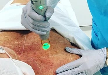 Pigmentation on shoulder and décolletage being treated with laser.