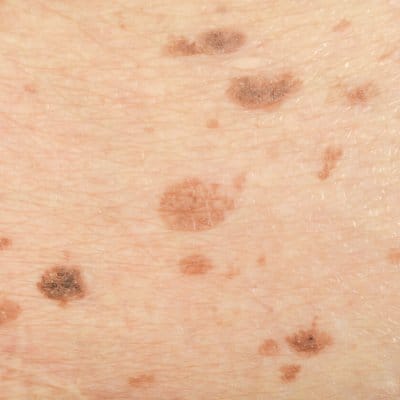 Close-up of skin with visible freckles.
