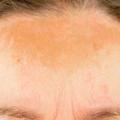 Melasma on a woman’s forehead.