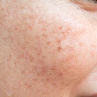 Age spots on cheek