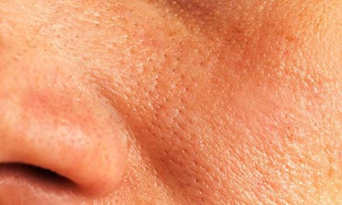 Close-up of a person’s cheek showing enlarged and blocked pores.