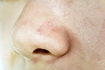 Close-up of skin showing whiteheads on the left side of the nose and cheek.