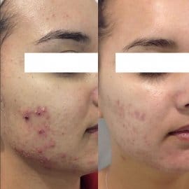 Before and after comparison showing reduced pustules and clearer skin after acne treatment.