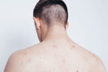 Post-Inflammatory Hyperpigmentation on male back