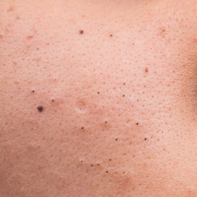 Close-up of skin showing visible blackheads.