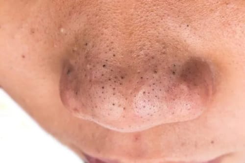 Close-up of a person’s nose showing visible blackheads and slightly enlarged pores.