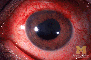 File:Anterior-uveitis.jpg
