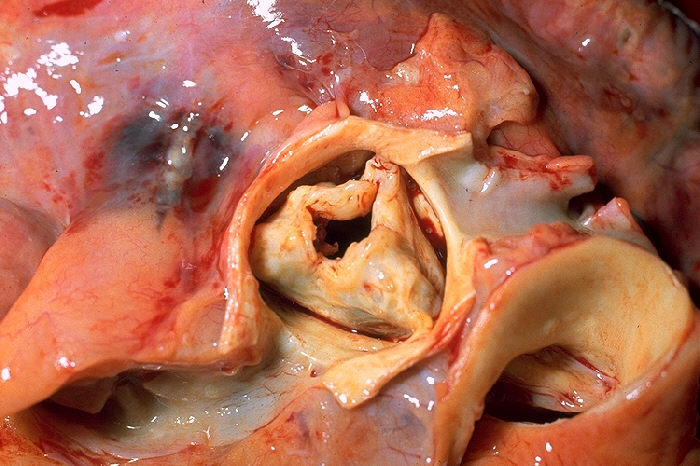 File:Aortic stenosis rheumatic, gross pathology 20G0014 lores.jpg