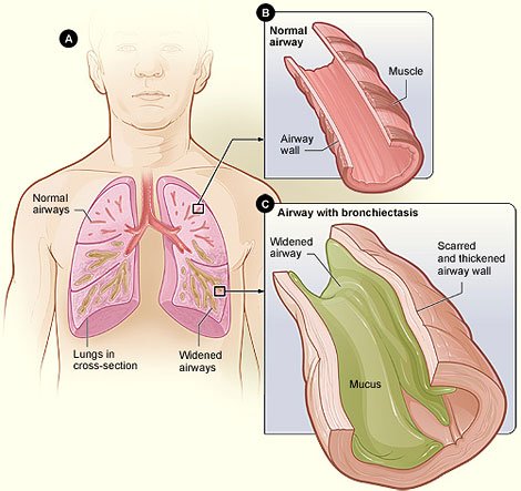 File:Bronchiectasis NHLBI.jpg