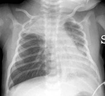 File:Bronchiolitis chest X-ray.jpg