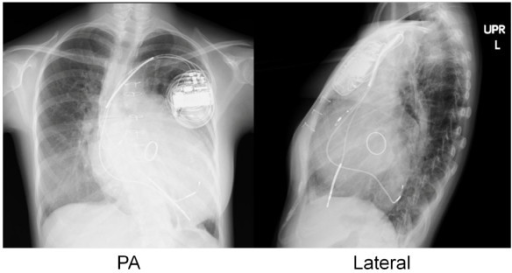 File:CRT in dilated cardiomyopathy and mitral valve replacement.png