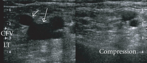 File:Compression of Femoral Vein.png