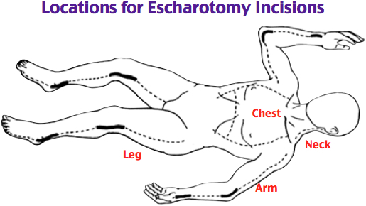 File:Content image - locations for escharotomy incisions.jpg