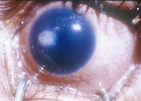 File:Corneal ulcer.jpg