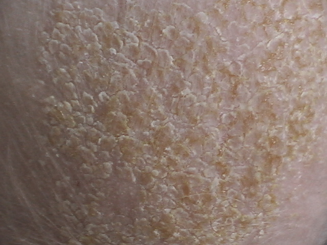 File:Cradle Cap Detail.jpg