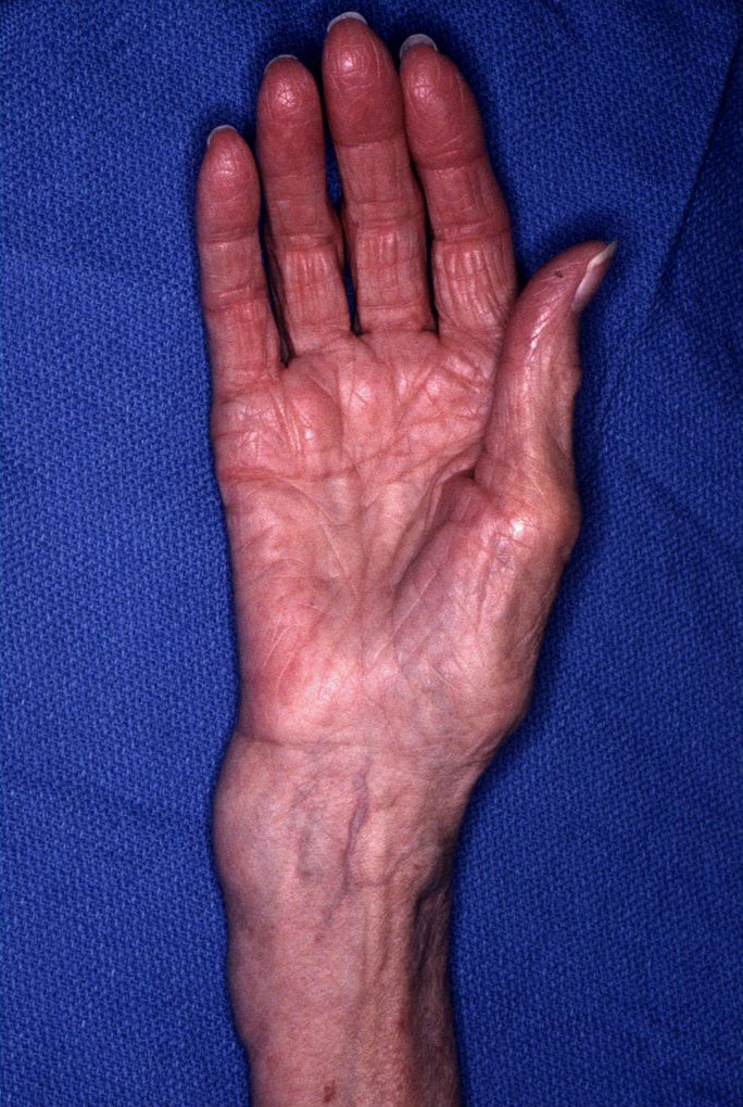 Distalradiusfracture.jpg
