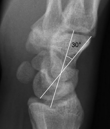 Dorsal Intercalated Segment Instability.jpg