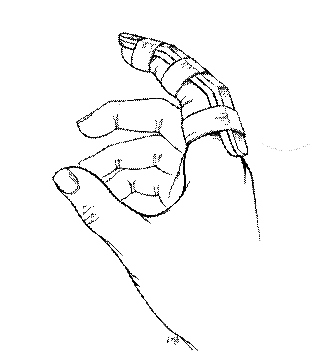 Dorsal Volar Finger Splint.gif