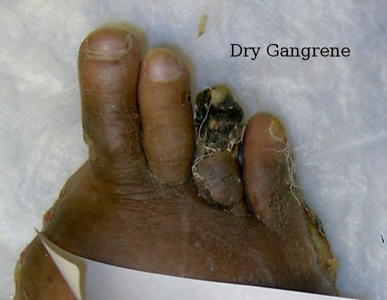 File:Dry gangene 4th toe.jpg