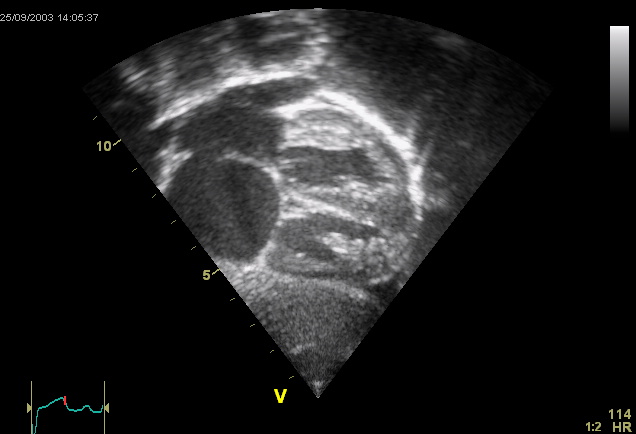 File:Echokardiogram von Atriumseptumdefekt (Ostium secundum).jpg