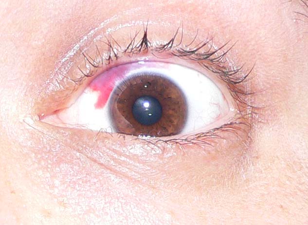 File:Eye hemorrhage.jpg