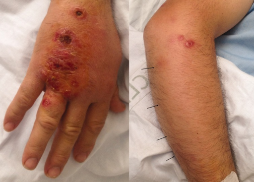 File:Fish tank granuloma 4.png