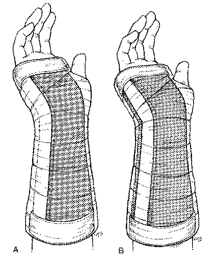 Forearm Volar Splint.gif
