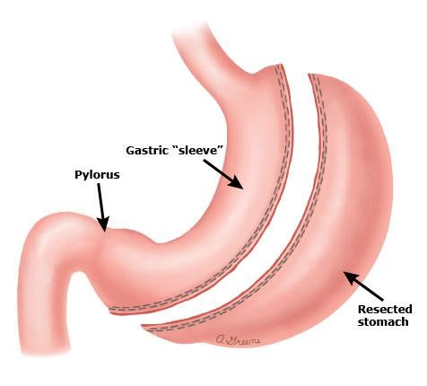 File:Gastric sleeve.png