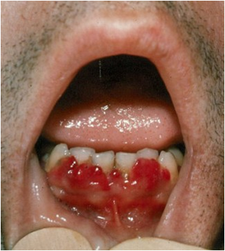 File:Gingival bleeding.png