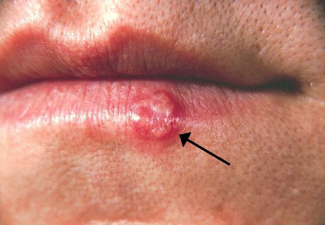 File:Herpes(PHIL 1573 lores).jpg