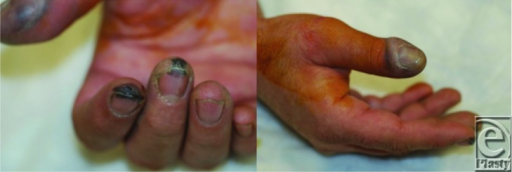 File:Hydrofluoric acid burn.png