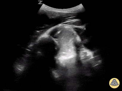 File:In-Vivo Shoulder Reduction Rutz.gif