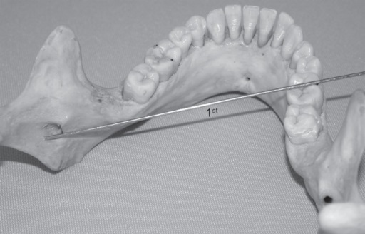 File:Inferior Alveolar Nerve Target.jpg