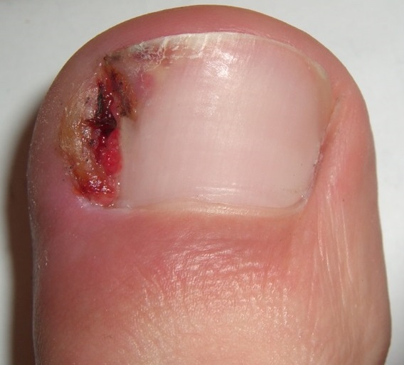 File:Ingrown nail 002 cropped.jpg