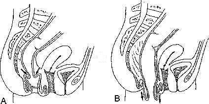 File:Internalrectalintussusceptionexternalrectalprolapse.jpg