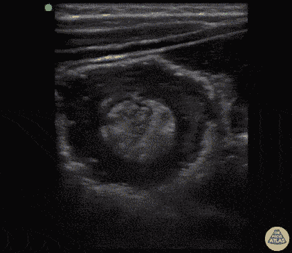 File:Intussusception Subramaniam.gif