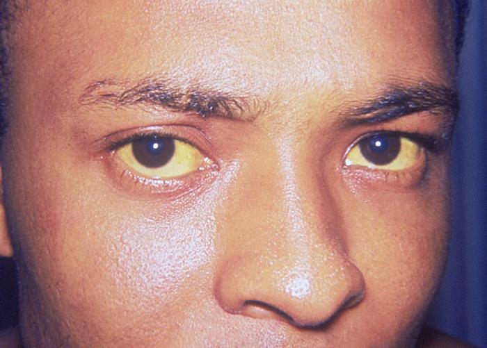 File:Jaundice eye.jpg