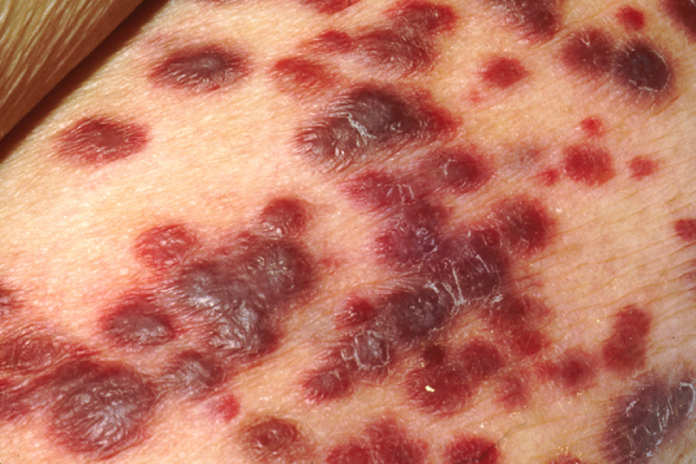 Kaposis Sarcoma Lesions.jpg