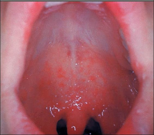 Koplik's Spots on Palate.jpg