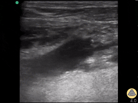 File:Lemierre Kilpatrick.gif