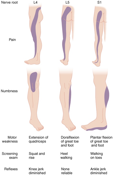 Lumbar Nerve Root Compromise.jpg