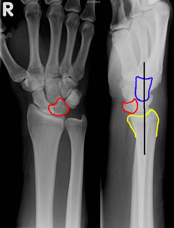 Lunate Dislocation.jpg