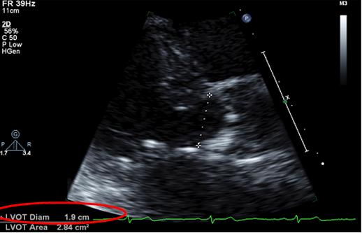 File:Lvot diameter.jpg