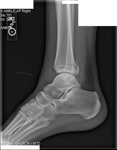 Maisonneuve fracture.jpg