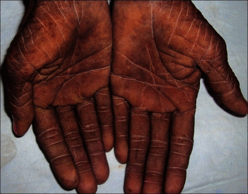 File:Malignant acanthosis nigricans ovarian.png