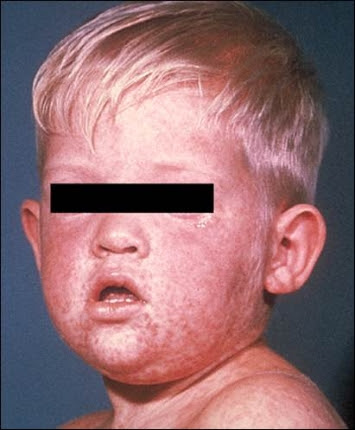 Measle's Rash on Face.jpg